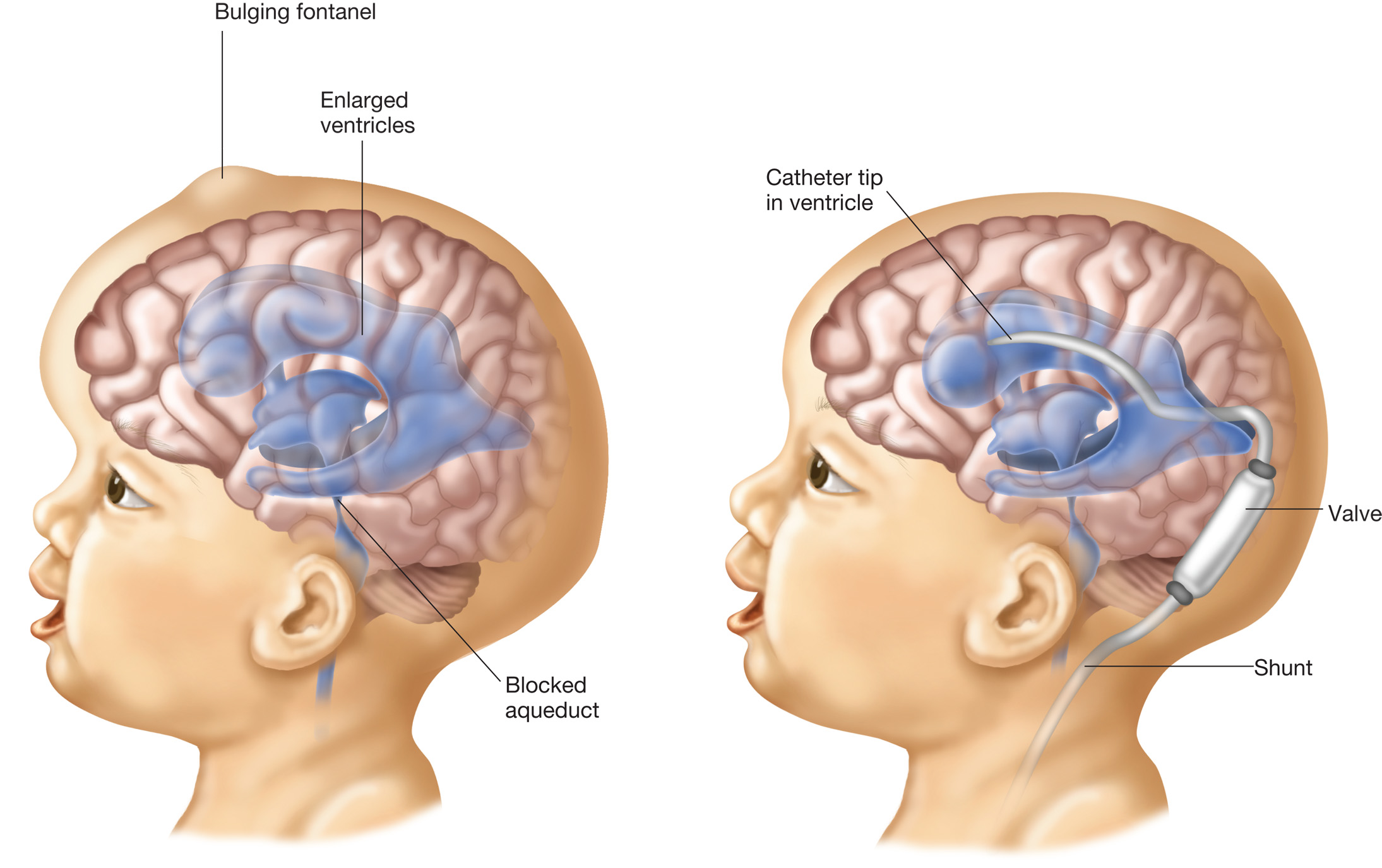 Hydrocephalus Treatment in Vapi