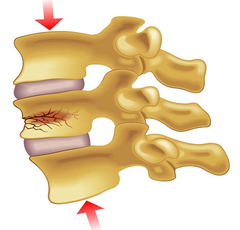 Spine Fracture Treatment in Vapi