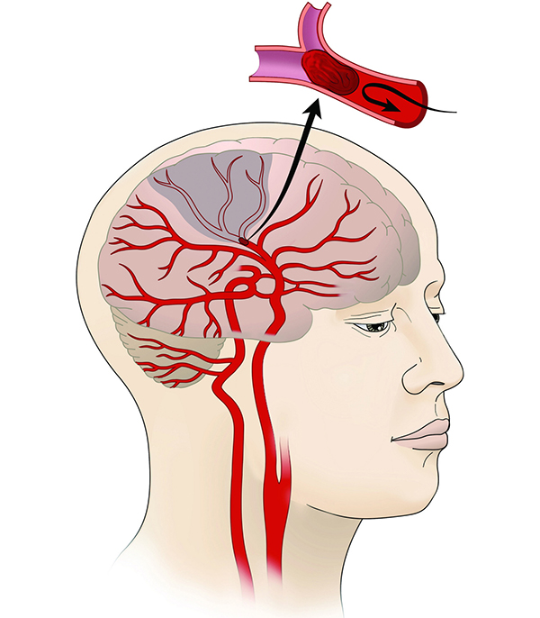 Stroke Treatment in Vapi